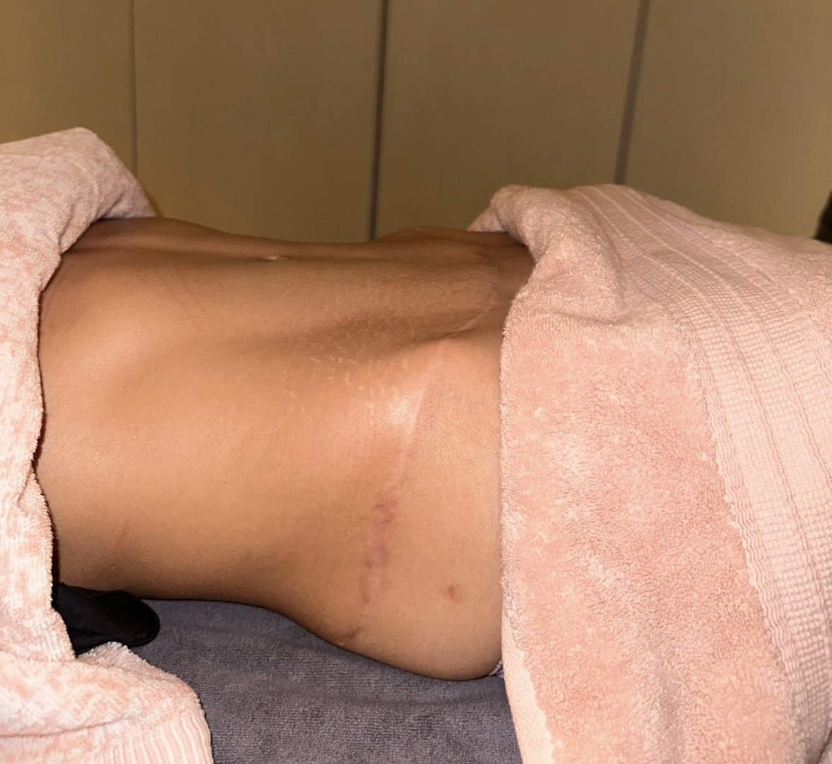 Tummy tuck — 9 months post-op, after a course of lymphatic drainage with Cyan