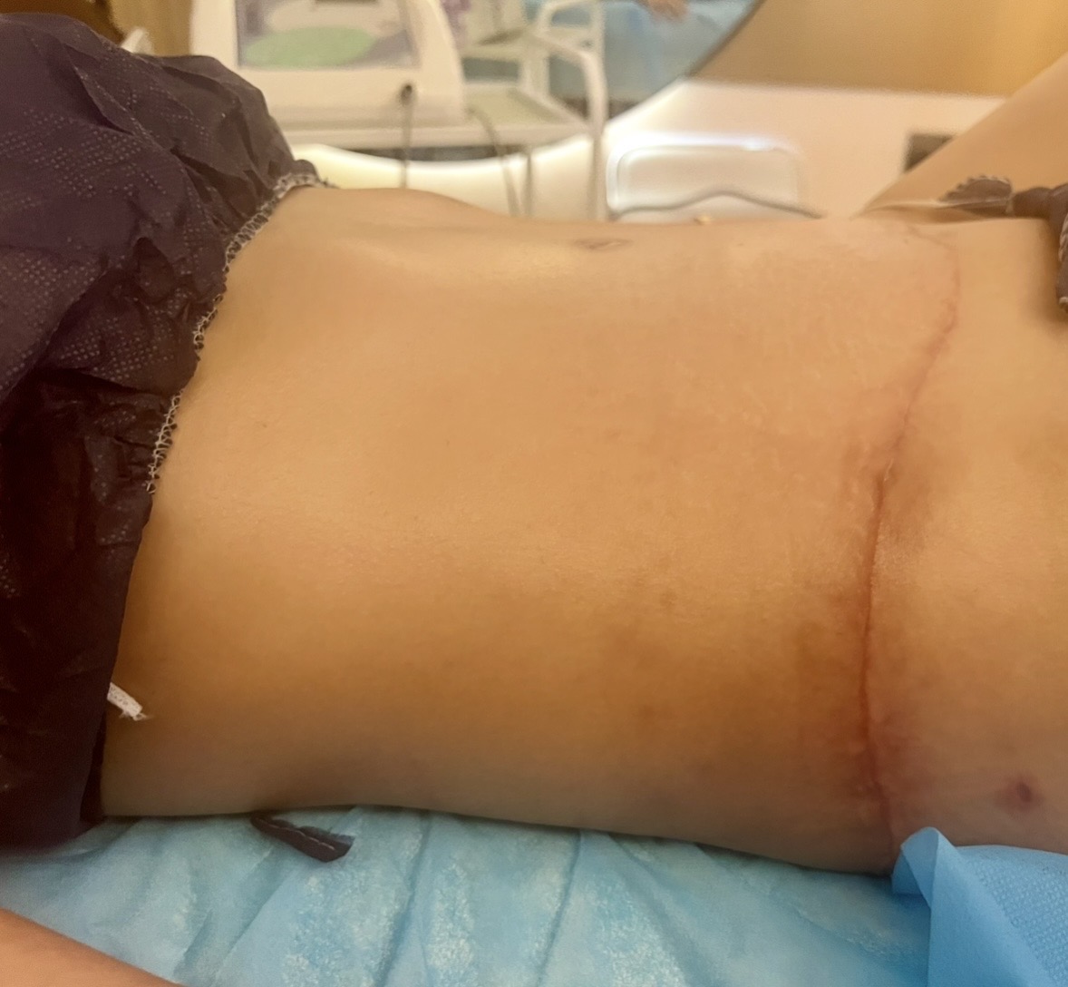Tummy tuck — 1 month post-op, before consistent lymphatic drainage